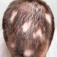 Alopecia Areata image 2