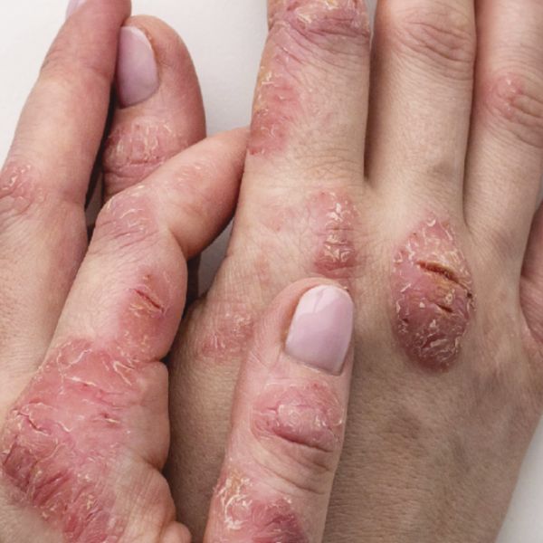 Eczema image 1