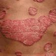 Psoriasis image 2