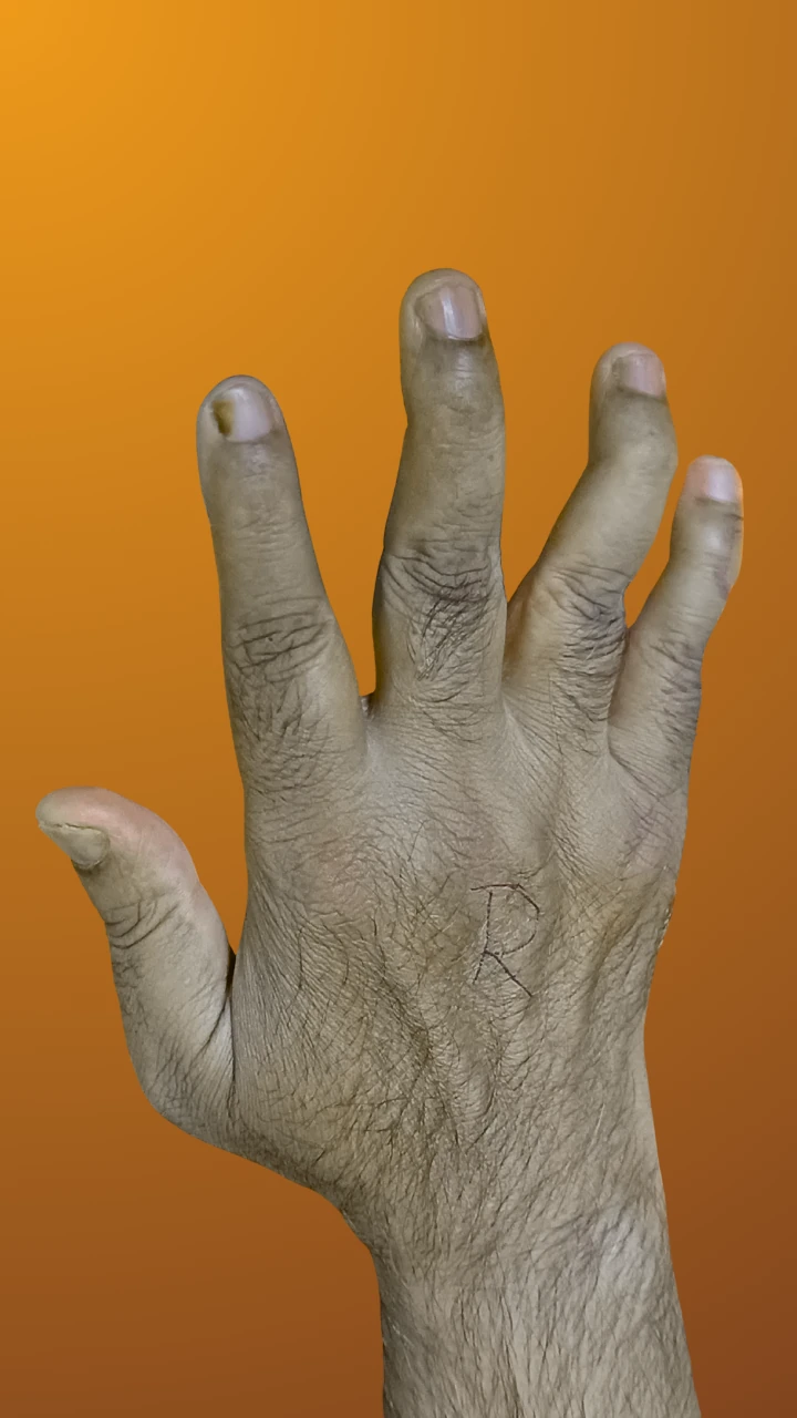 Psoriatic Arthritis image 1