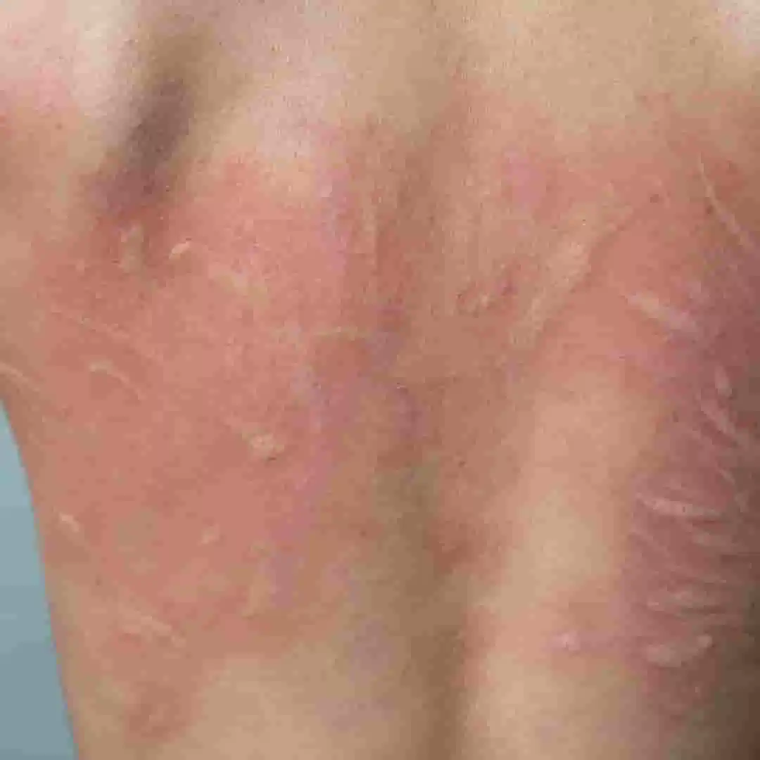 Urticaria (Hives) image 1