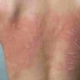 Urticaria (Hives)