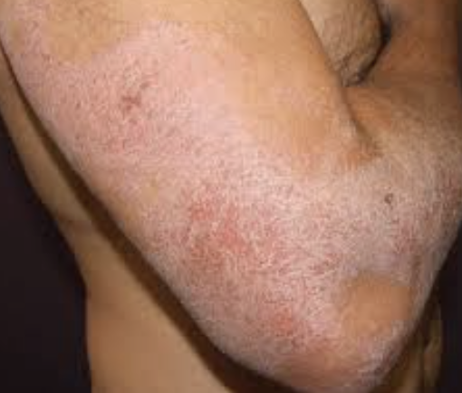 Atopic Dermatitis